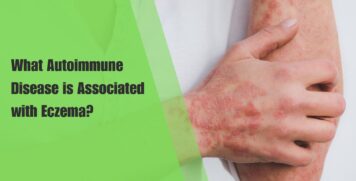 What Autoimmune Disease is Associated with Eczema?