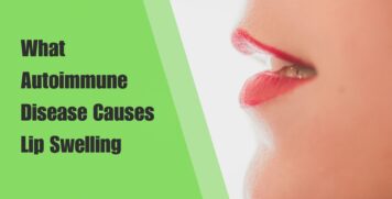 What Autoimmune Disease Causes Lip Swelling