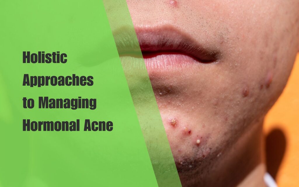 Holistic Approaches to Managing Hormonal Acne