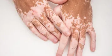 Close-up of hands with vitiligo showing areas of skin depigmentation on fingers and wrists