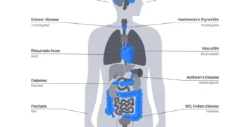 Medical diagram illustrating common autoimmune diseases and the specific organs or tissues they target