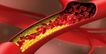 Cross-section illustration of an artery showing red blood cells flowing past yellow cholesterol plaque build-up.